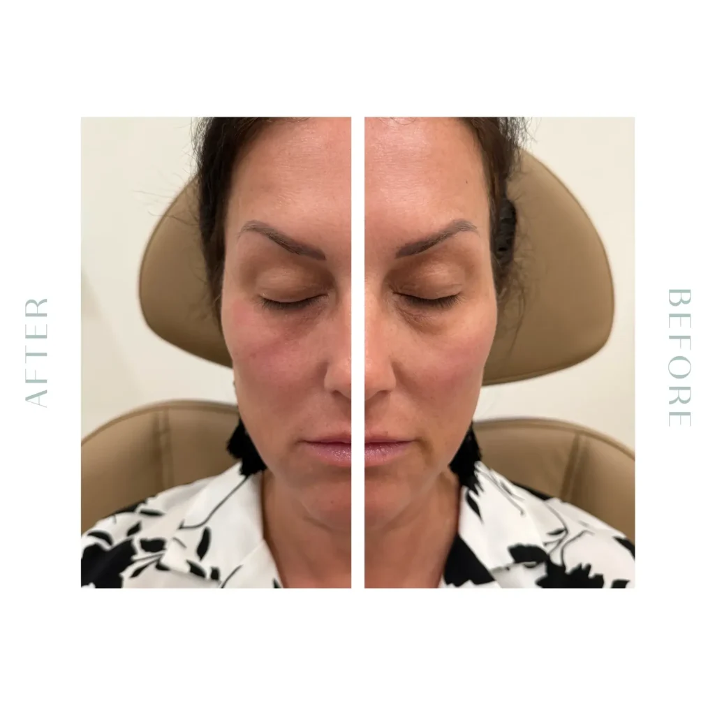 Best Treatment for Sunken Eyes in Charleston, SC