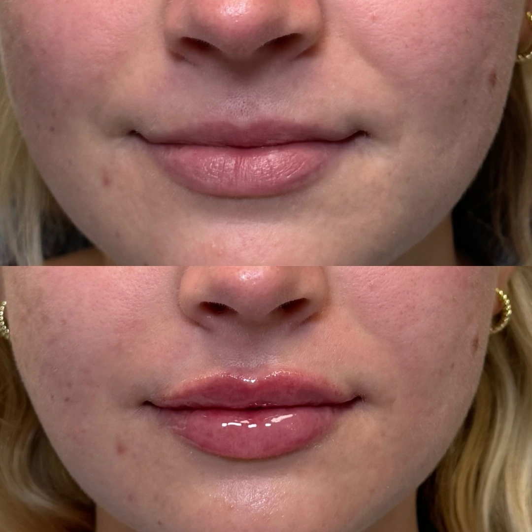 Lip Filler Before & After 3 (1)