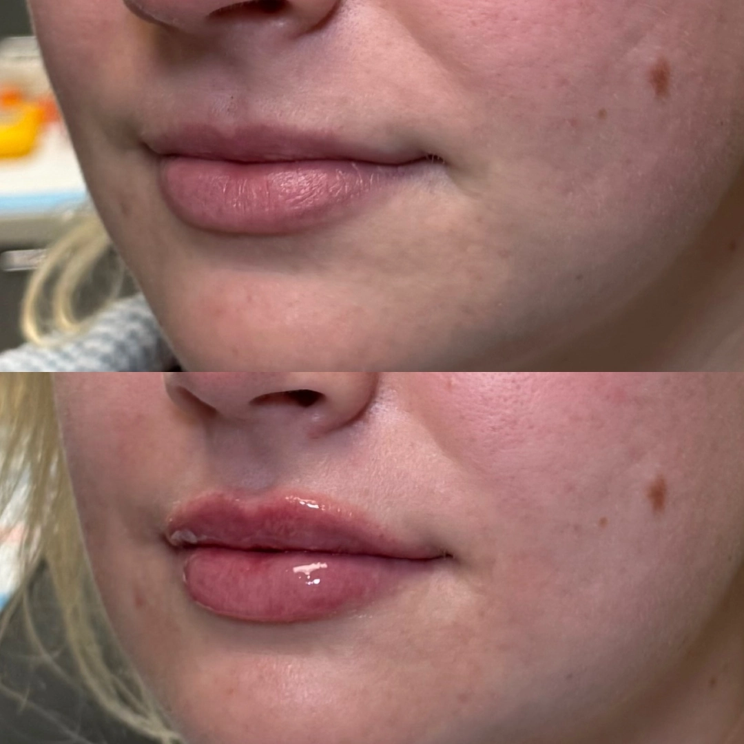 Lip Filler Before & After 4