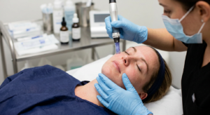 How Many Microneedling Sessions Do You Really Need? A Treatment Timeline for the Best Results